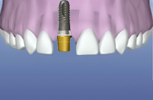 Gắn abutment